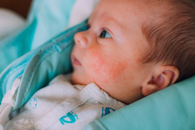 ¿Cuáles son las causas de las alergias de los bebés?